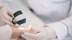 Zespół larwy skórnej wędrującej - przyczyny, objawy i leczenie