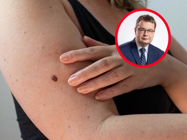 Takie zmiany powinny zaniepokoić. "Udajmy się do dermatologa"