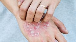 Pierścień Woronoffa - przyczyny, objawy i leczenie