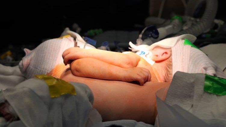 7-tygodniowe bliźniaczki syjamskie rozdzielone