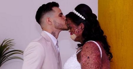 Znalazła miłość i urodziła dziecko. Z powodu nieuleczalnej choroby jest nazywana potworem