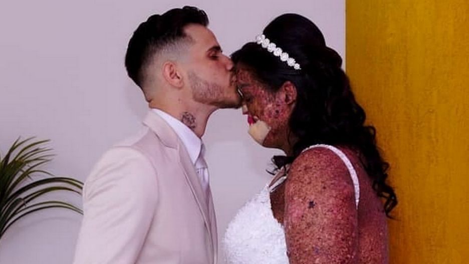 Przez rzadką chorobę straciła wargę i kawałek nosa.