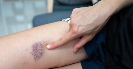 Siniaki wolno się goją, rany obficie krwawią. Znak, że brakuje ważnej witaminy