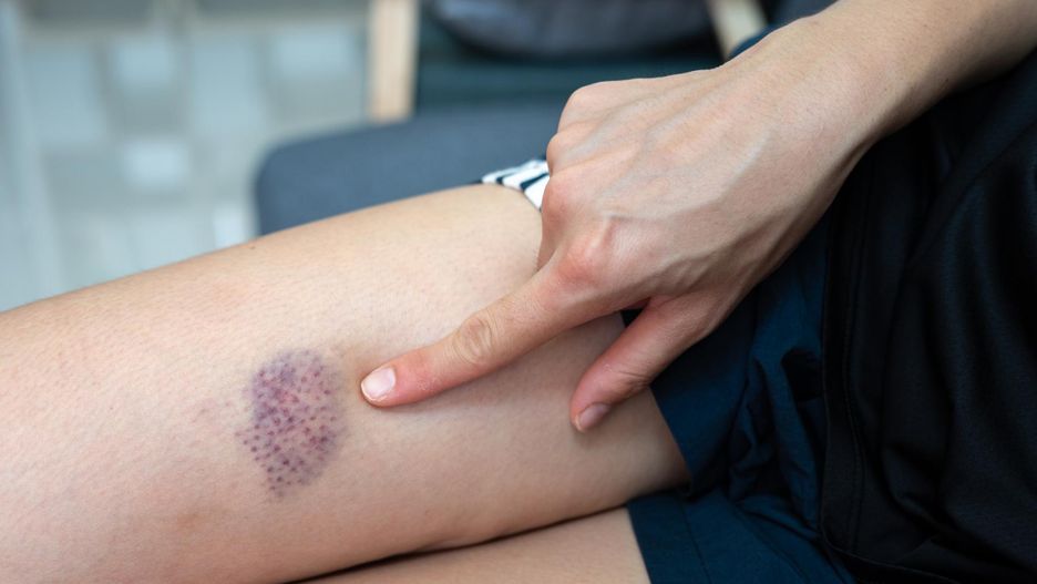 Wolno gojące się rany i obfite krwawienia? Jakie jeszcze sygnały świadczą o niedoborze witaminy K?