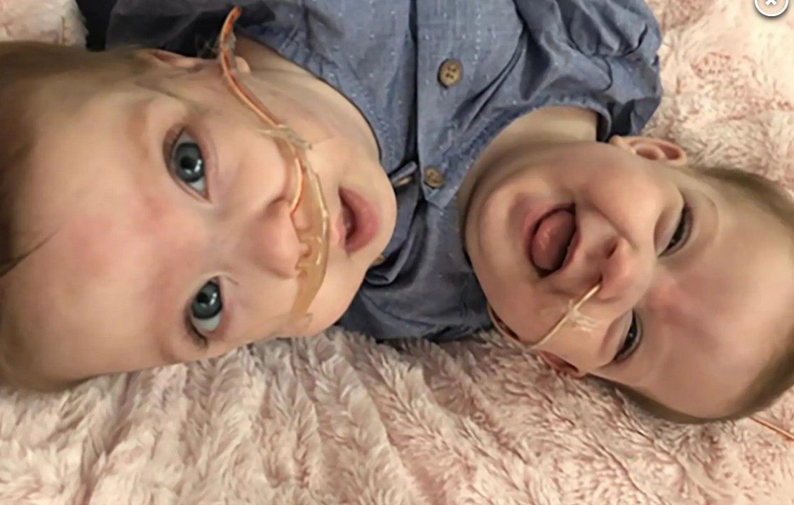 Bliźniaczki syjamskie