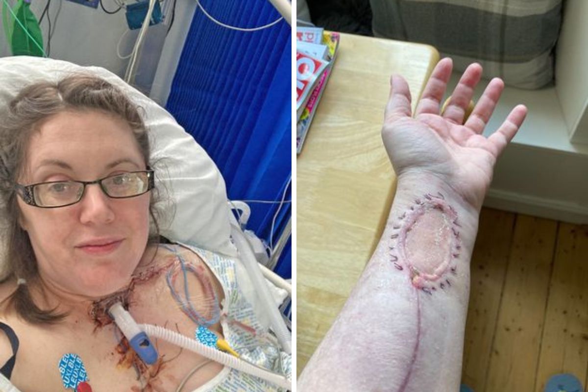 Lekarze musieli przeszczepić tkanki z przedramienia