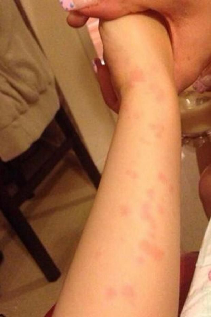 Nastolatka jest tak uczulona na zimno, że zimą ledwo może wyjść z domu