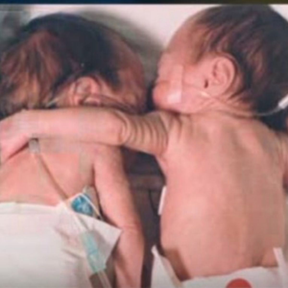 Jedna z bliźniaczek objęła swoją siostrę i uratowała jej życie.