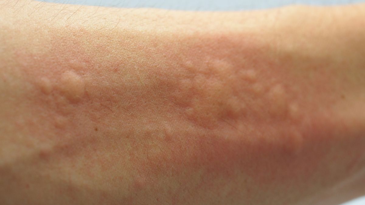 Jak leczyć pokrzywkę? Waro zacząć od wyeliminowania jej wyzwalaczy