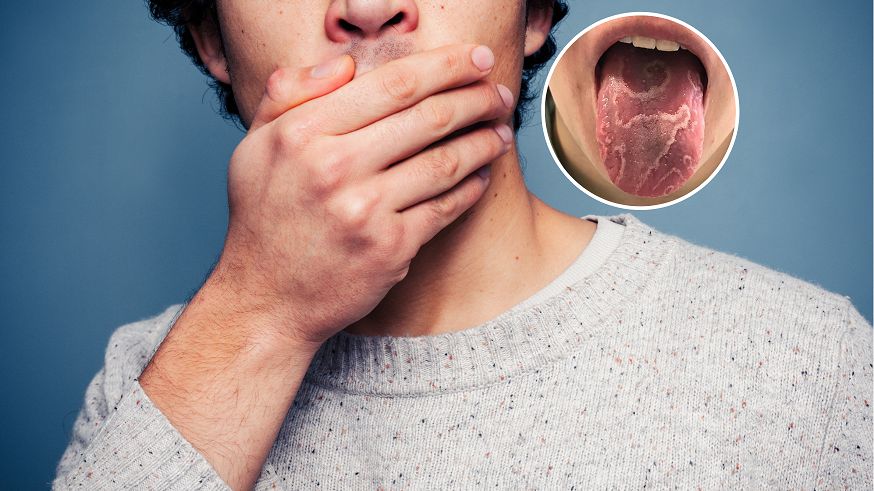 Język geograficzny powinien zaniepokoić. Tak może objawiać się cukrzyca