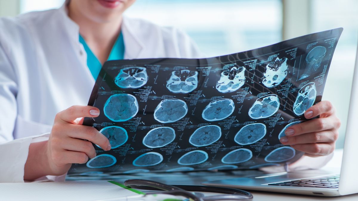 Mielinoliza środkowa mostu to rzadki zespół neurologiczny związany z niskim poziomem sodu we krwi.