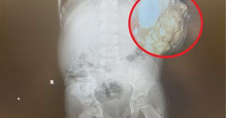 5-latek miał biegunkę i skurcze. Oto co wyciągnęli z jego żołądka