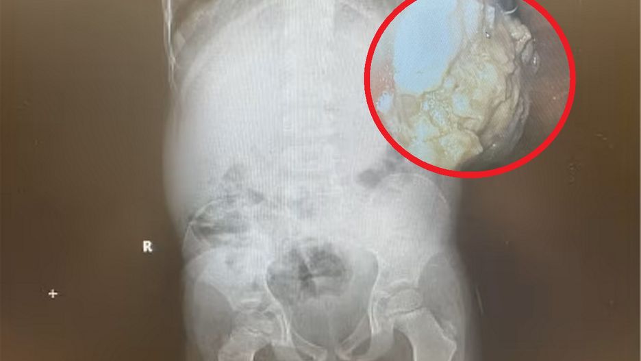 Połknięcie gumy przed dziecko