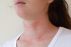 Omikron "zjada" kolagen? "Covidowa skóra" to problem, który dotyka wielu zakażonych nowym wariantem