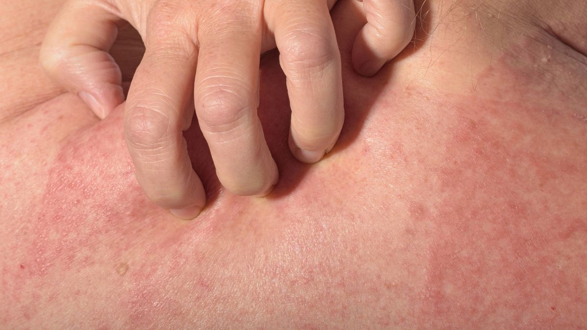 Wysypka może mieć postać drobnych plamek, krostek, ale i pęcherzy