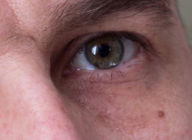  Zmiany zabarwienia białek oczu mogą świadczyć o rozwoju raka płuc