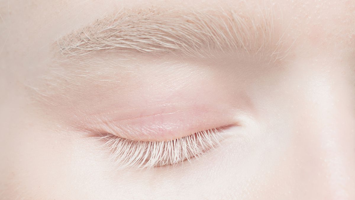 Albinizm: objawy i leczenie