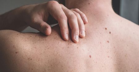 Dermatolog ostrzega. Przez powszechne błędy narażamy się na raka skóry