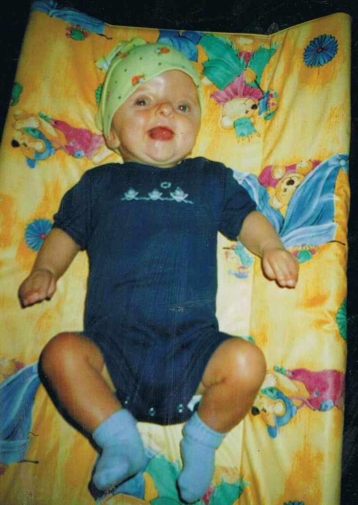 Kaia choruje na Zespół Aperta