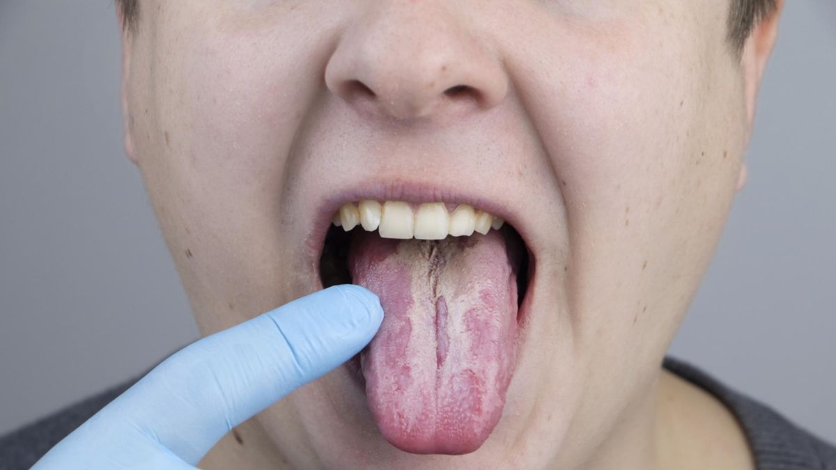 Zauważyłeś na języku? Tak może objawiać się groźna choroba