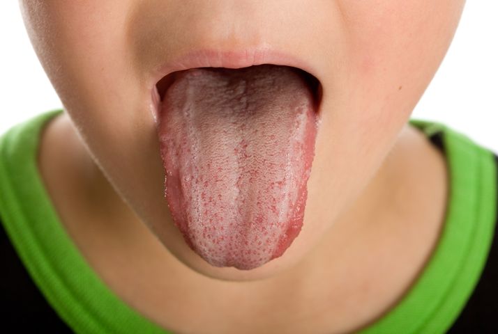 Żółty nalot na języku może być związany z refluksem dwunastnico- żołądkowym.