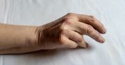 Przykurcz Dupuytrena – co to? Przyczyny, objawy, operacja
