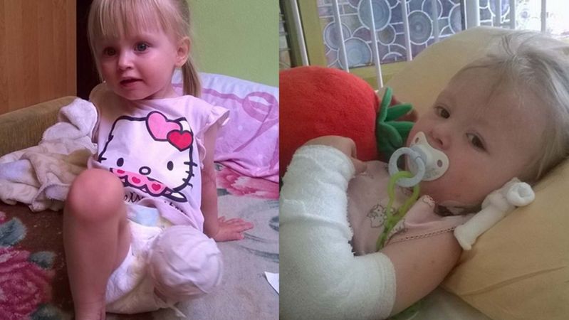 2-letnia Natalka straciła nóżkę przez pijanego kierowcę. Prośba o wsparcie