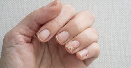 Przyjrzyj się, zanim wykonasz manicure. Ten objaw raka zobaczysz gołym okiem