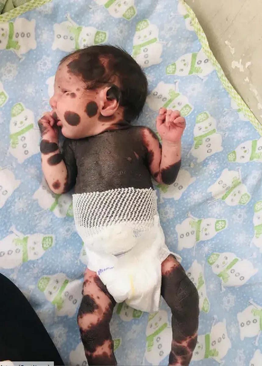 Chłopiec-panda kończy 3 lata. Lekarze sądzili, że przeżyje 10 dni