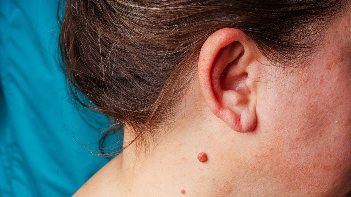 Brodawki na szyi to zmiany skórne wywołane wirusem HPV