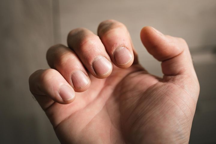 Wygląd palców może zdradzać groźną chorobę. Czym jest strzelający palec?