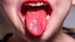 Objawy szkarlatyny u dzieci - konkretne symptomy, leczenie