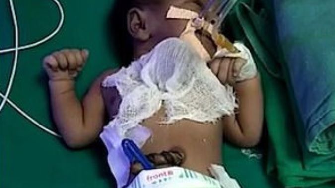 Ektopia serca to rzadka wada wrodzona. Występuje z częstością od 5 do 8 przypadków na 1 mln urodzeń.