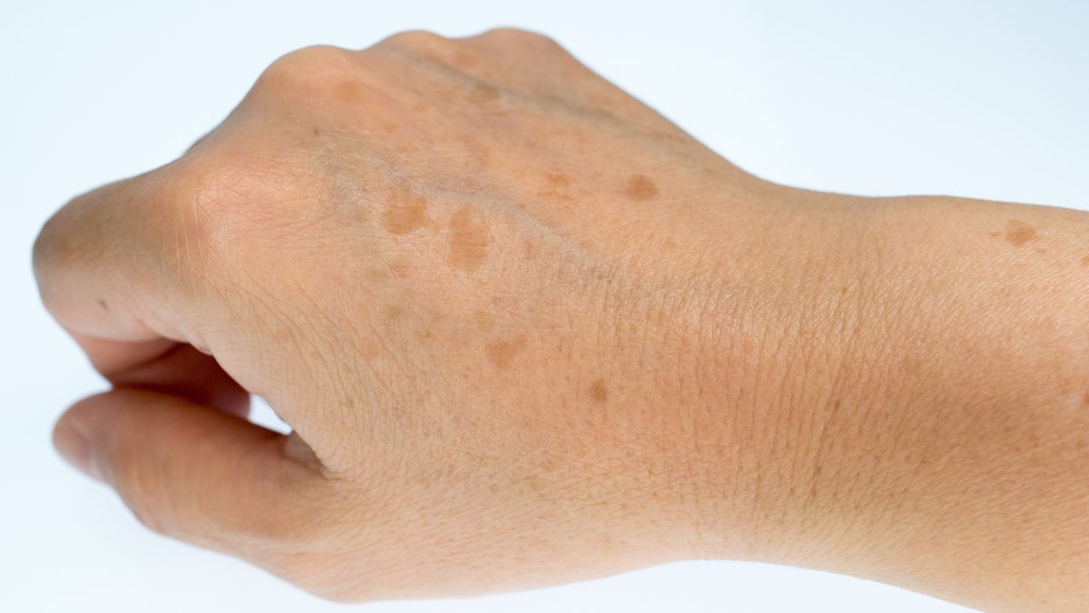 Plamy wątrobowe to skutek nadmiernej ekspozycji skóry na słońce.