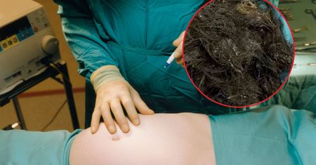 14-latka latami zjadała swoje włosy. "Zapchały żołądek i jelita"
