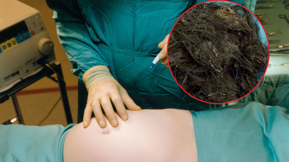 Lekarze wyciągnęli 3 kg włosów