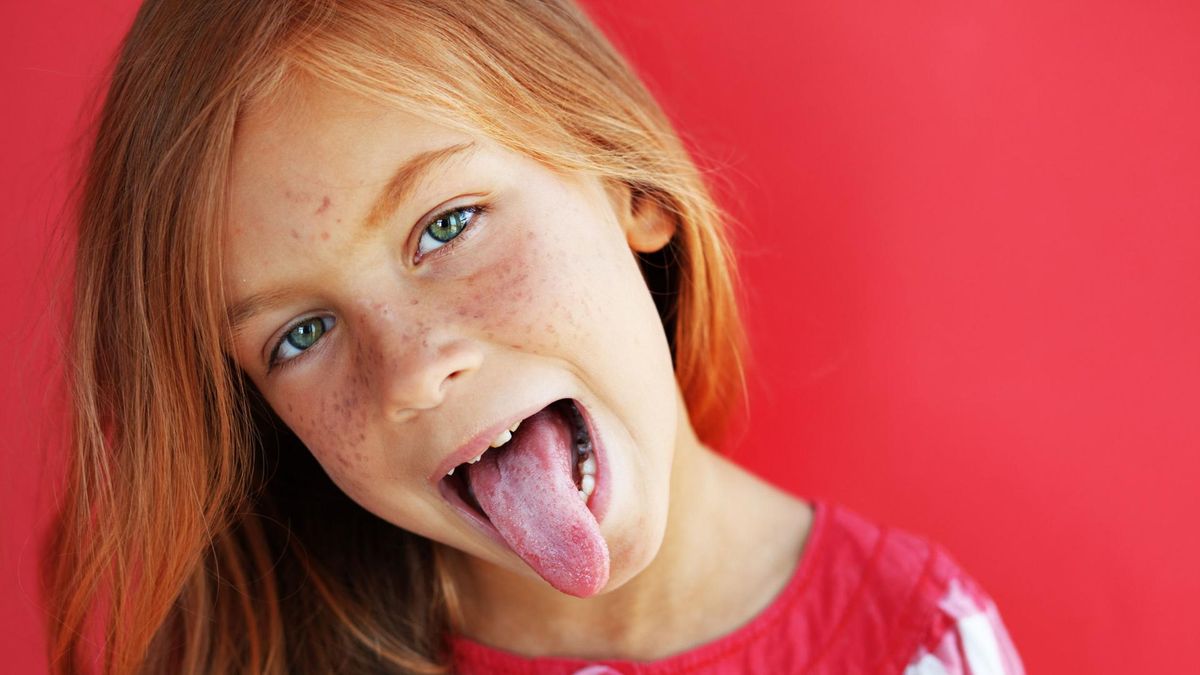 Zespół krowiego języka