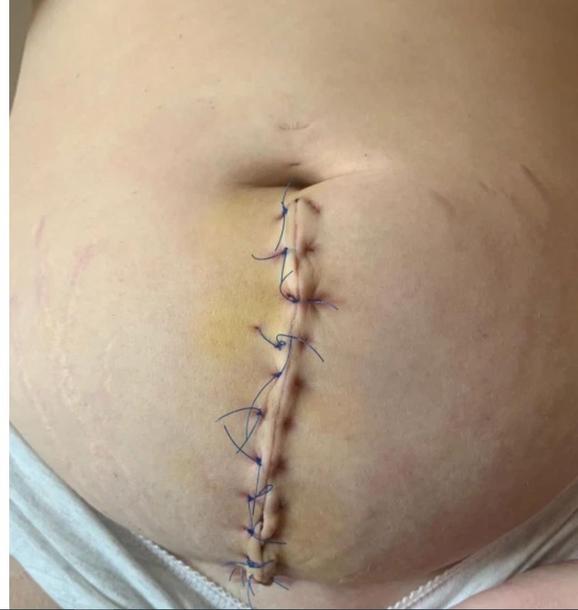 Torbiel w żołądku 