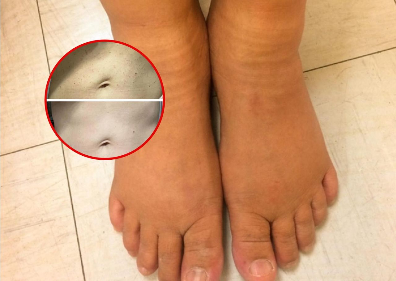 "Rubinki" na skórze. Gdy się pojawią, pędem do lekarza