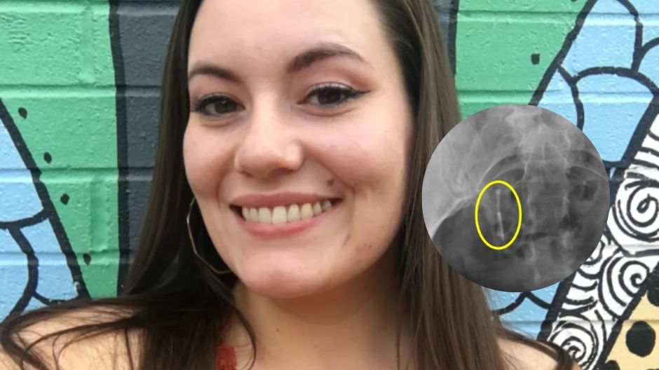 Przez 12 lat miała w ciele pewien przedmiot. Lekarze znaleźli go w jelicie grubym