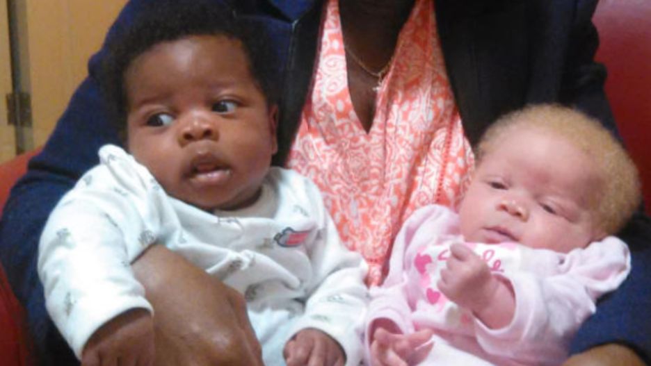 Jedno z bliźniąt urodziło się z albinizmem. Wyjątkowe rodzeństwo ma już 10 lat