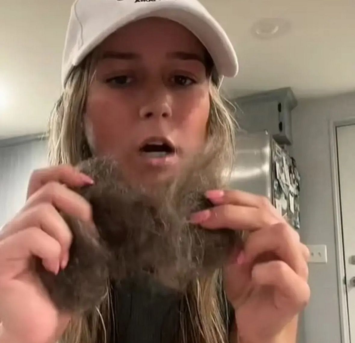 25-latka zaczęła łysieć