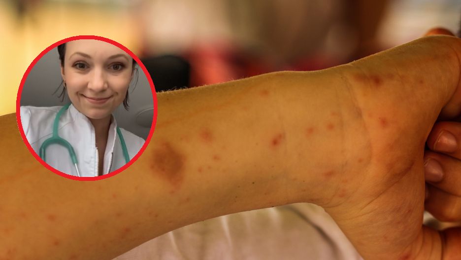 Lekarka ostrzega przed bolesną chorobą. "Teraz jest wysyp"