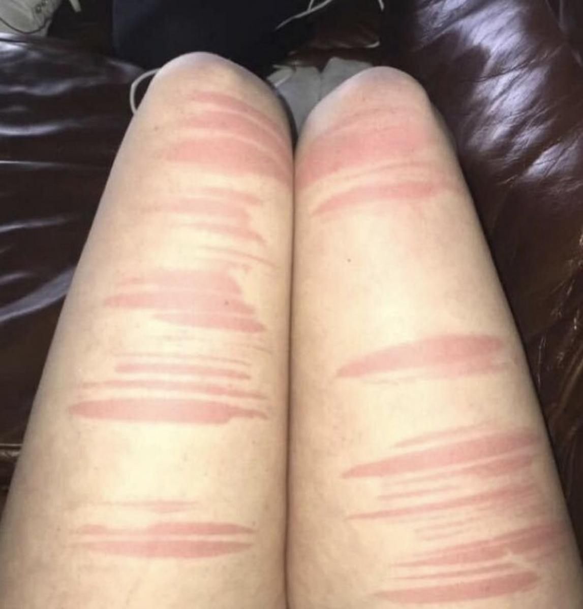 Noszenie jeansów z dziurami może prowadzić do poparzenia słonecznego