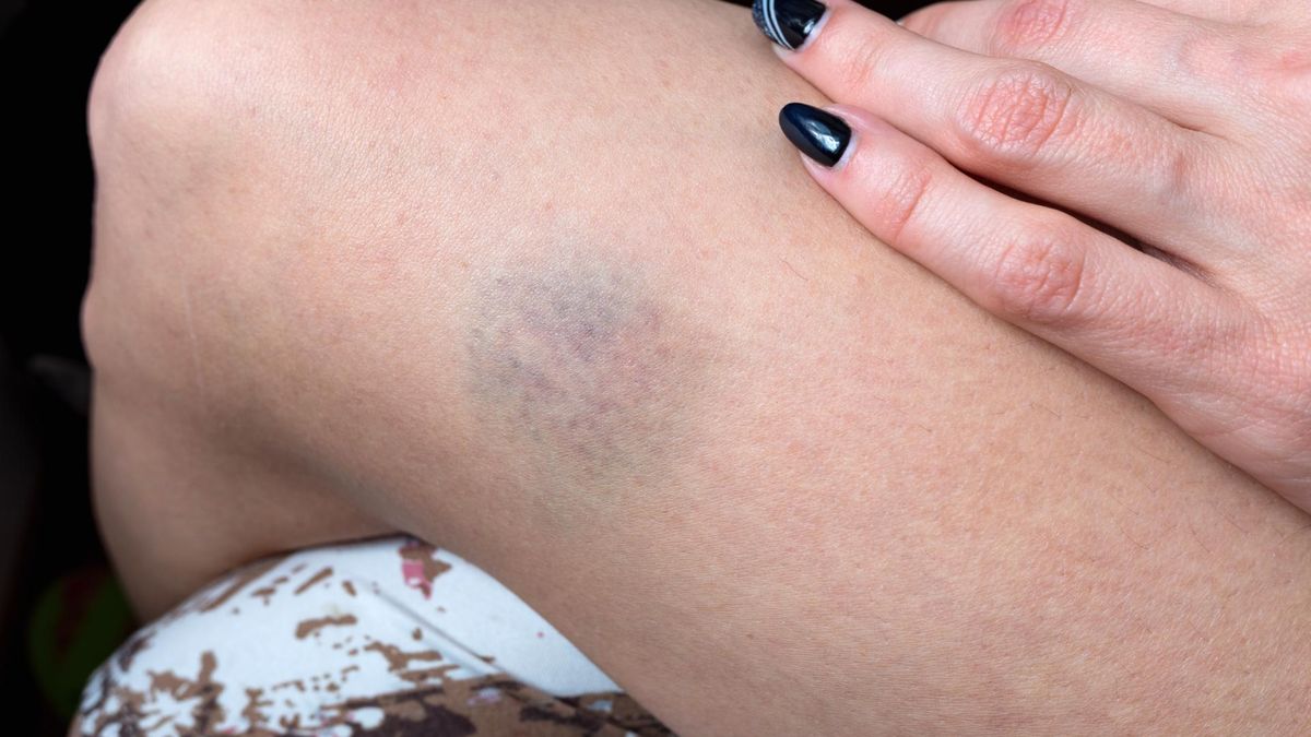 Siniaki mogą być objawem wielu chorób