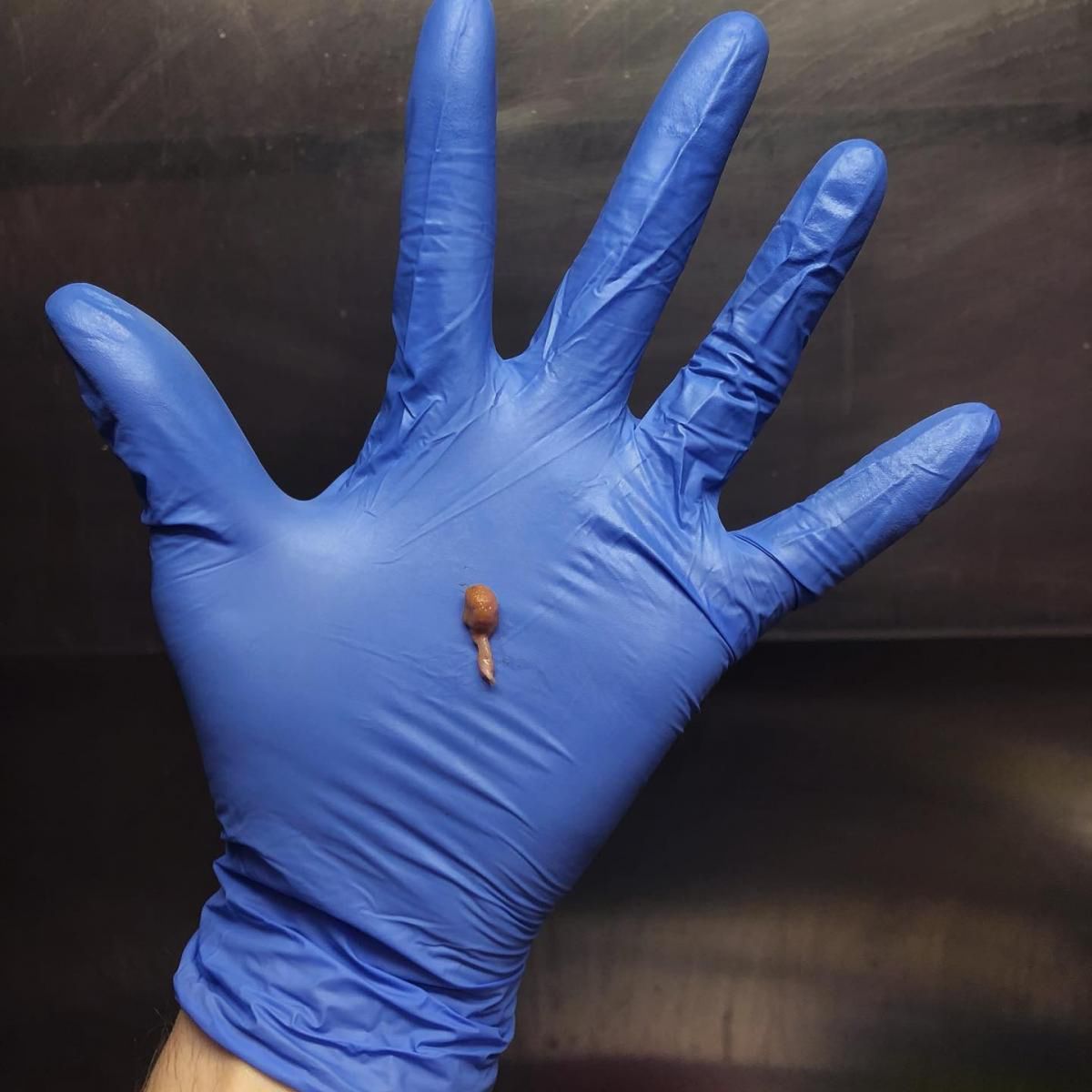 Polip jelita grubego może przekształcić się w raka 