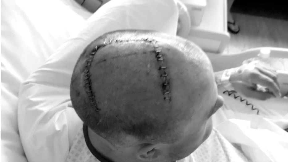 Bolała go szyja. Okazało się, że ma nowotwór mózgu