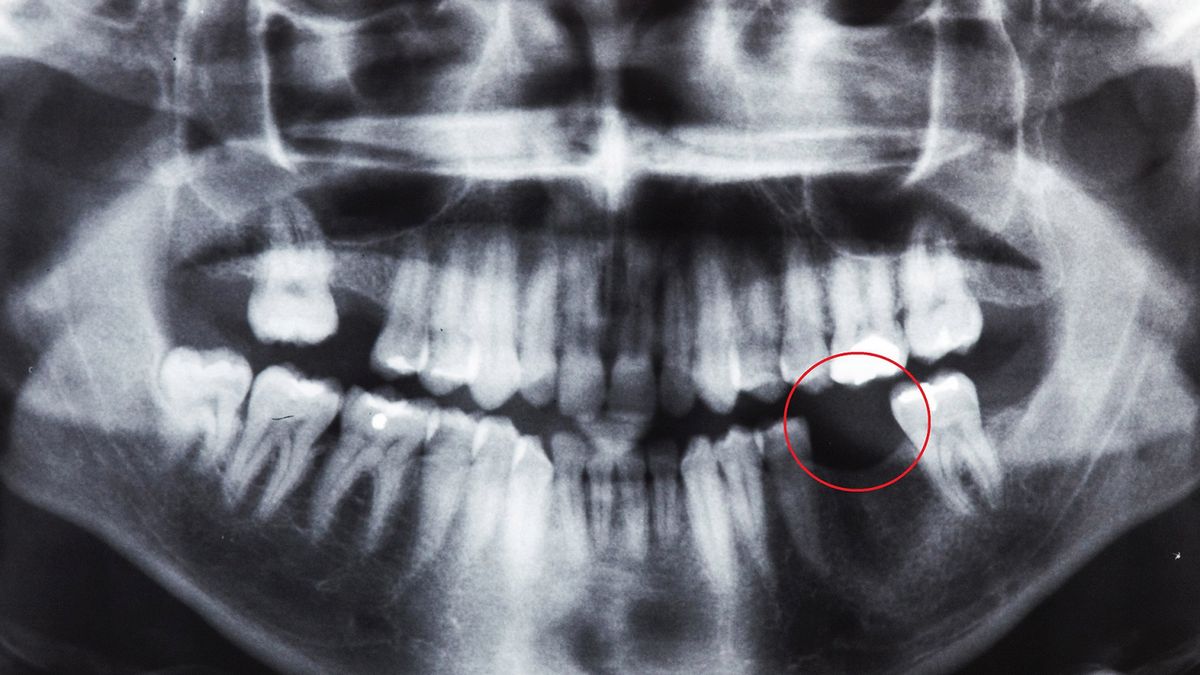 Choroby zębów narażają na cięższy przebieg COVID-19. "Umożliwiają wirusowi, przedostanie się do krwi".