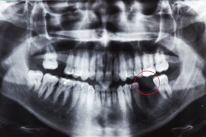 Choroby zębów narażają na cięższy przebieg COVID-19. "Umożliwiają wirusowi, przedostanie się do krwi".