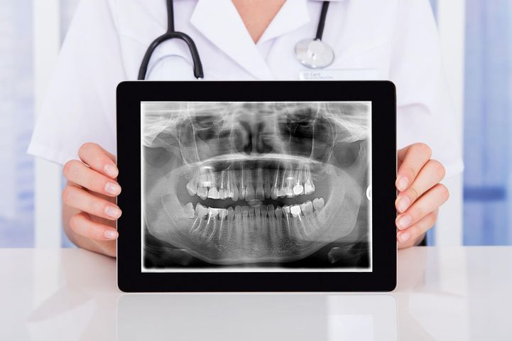 Pantomogram to specjalistyczne zdjęcie rentgenowskie (RTG), które uwidacznia zęby górne i dolne